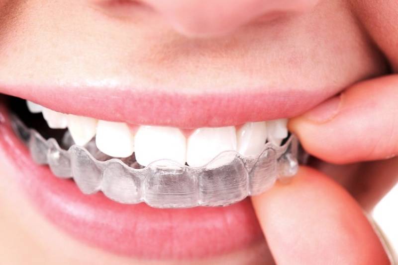 Le traitement par gouttières invisibles Invisalign